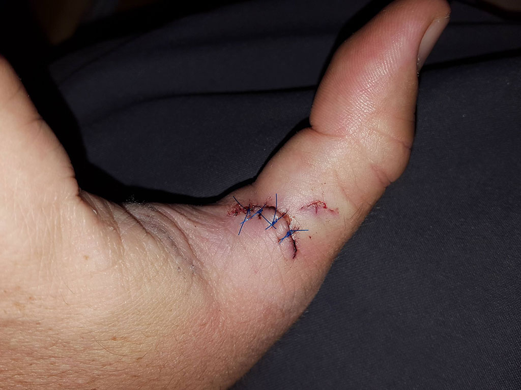 Matthew Randall's thumb with 4 stitches after being bitten by a musky.