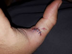 Matthew Randall's stitched-up thumb after a musky bite